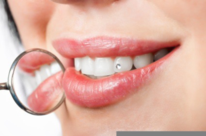 Why Should You Consider Dental Implants Treatment, Lawrenceville?