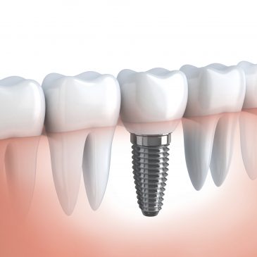 How Do Dental Implants Help If You Have Full Dentures in Lawrenceville?